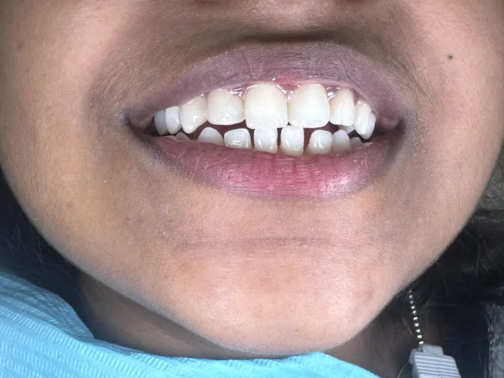 Smile design closing natural gaps between the front teeth — after