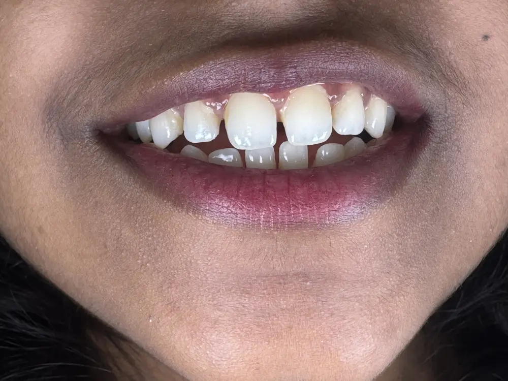 Smile design closing natural gaps between the front teeth — before