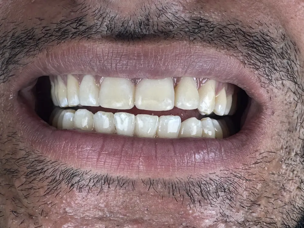 Smile design evening out tooth shade and shape — after