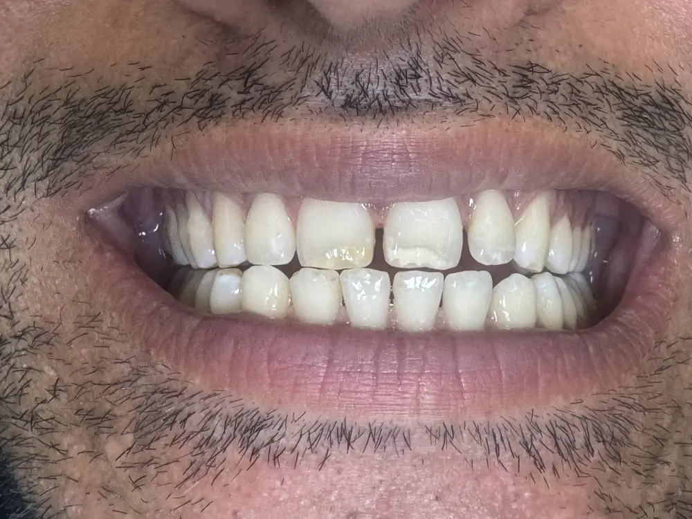 Smile design evening out tooth shade and shape — before